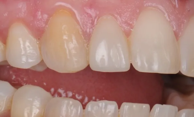 after Cosmetic Bonding