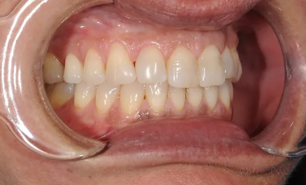 Cosmetic Bonding​- after