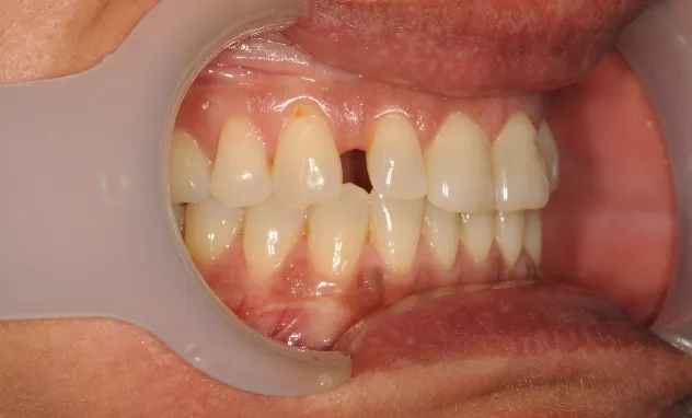 Cosmetic Bonding​- before
