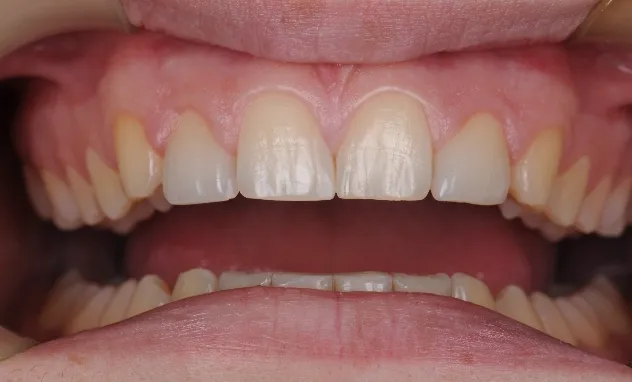 Cosmetic Bonding​- after