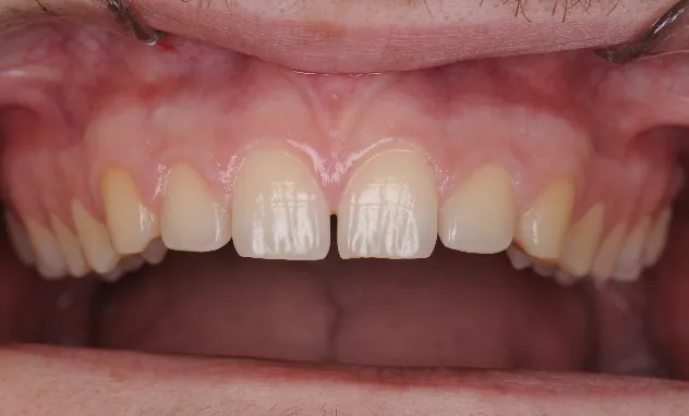 Cosmetic Bonding​- before
