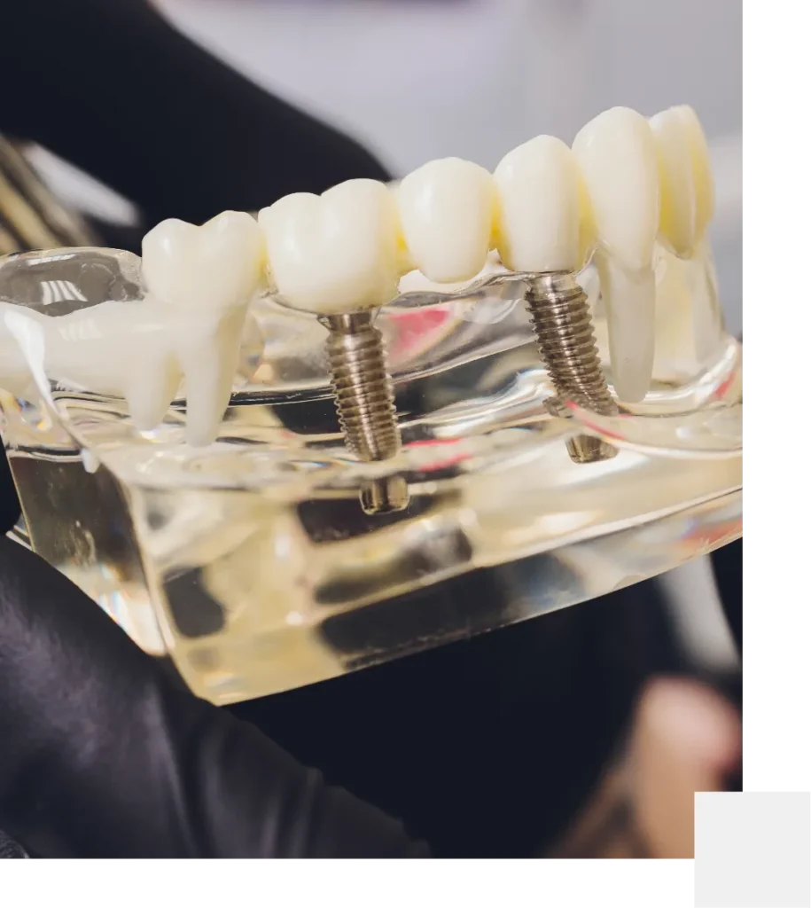Multiple dental implants in Mackay