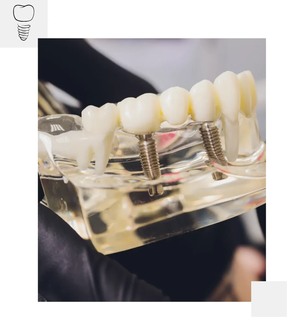 Multiple dental implants in Mackay