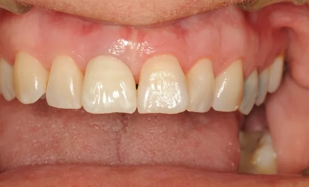 Implant Crowns​- after