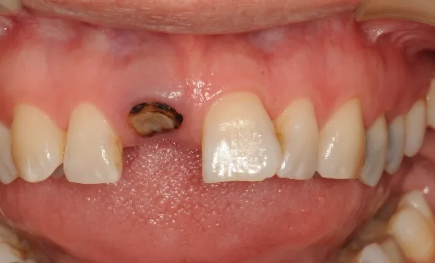 Implant Crowns​- after