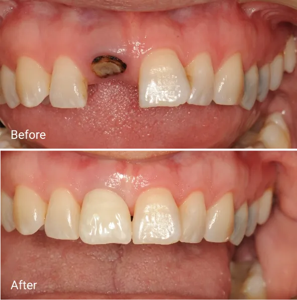 single implant Patient Transformations