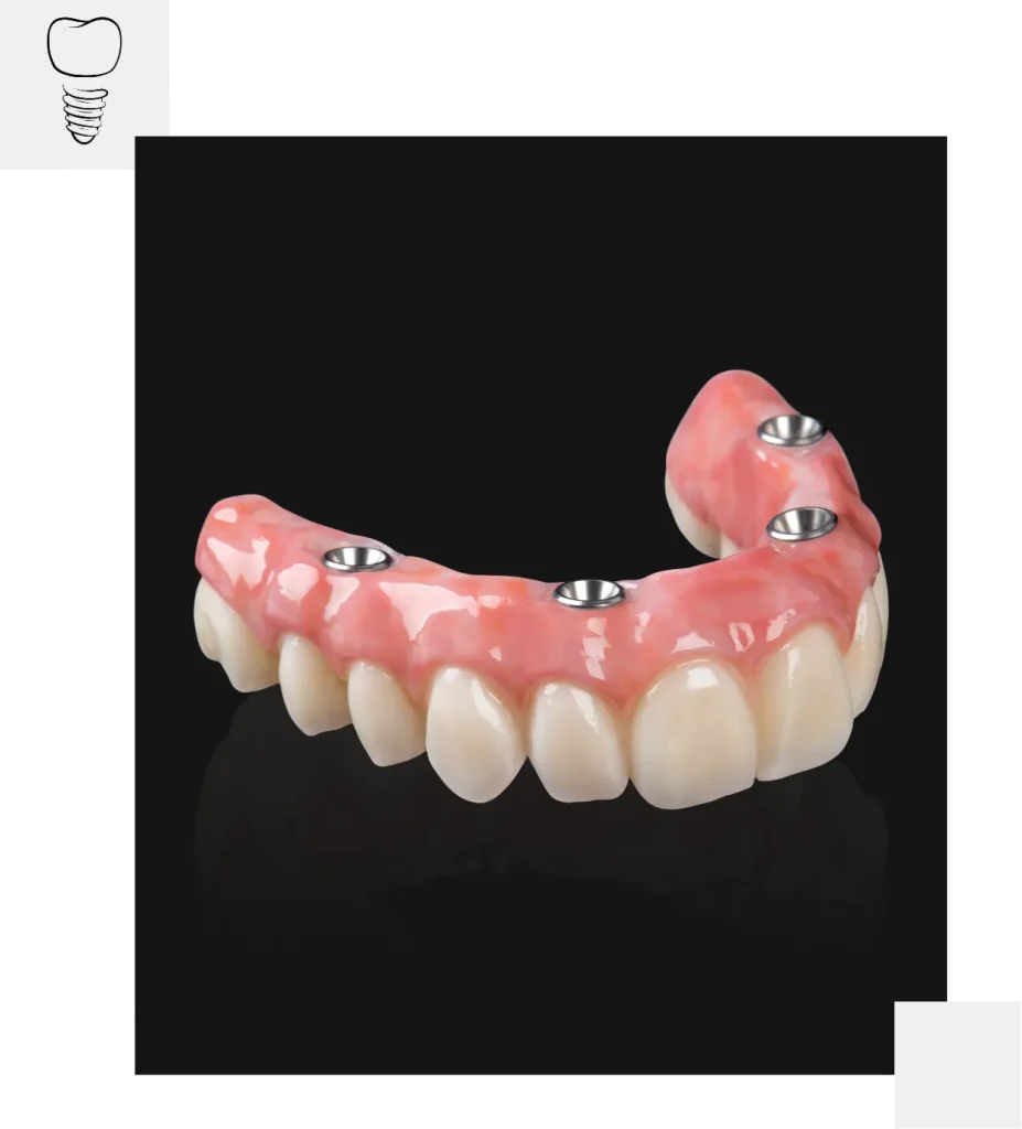 Full arch dental implants in Mackay