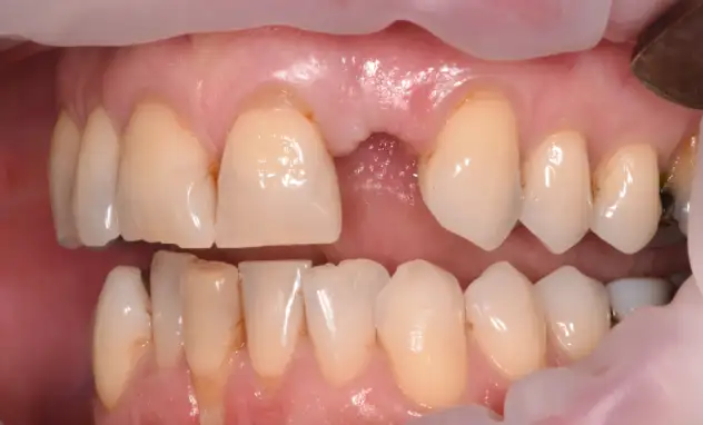 Implant Crowns​- before
