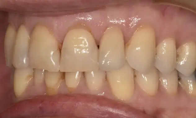 Implant Crowns​- after